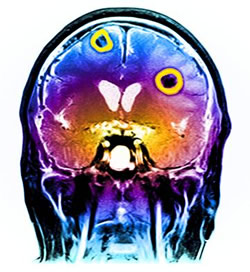 Galvos susirgimas: vėžinių smegenų auglių (geltonai apibrauktos zonos) formavimasis gali trukti iki dešimtmečio