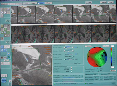 Koncentruotos ultragarso bangos kaitina taikinį smegenyse, tuo tarpu realiu laiku gaunami vaizdai informuoja chirurgus apie procedūros eigą