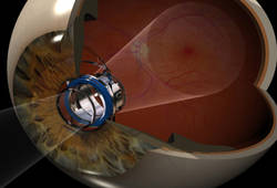 Sukurtas į akį implantuojamas teleskopas