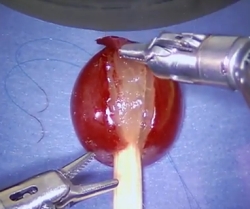 Robotas-chiruras sėkmingai atliko operaciją vynuogei