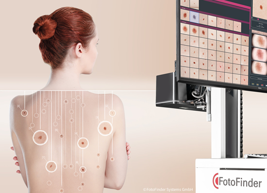 „FotoFinder“ pristato naujos kartos sistemas ankstyvam odos vėžio nustatymui