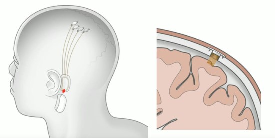 „Neuralink“ nuotr.