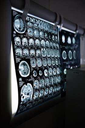 Mokslininkai tyrė mirštančias smegenis: pastebėjo aktyvumą, kuris gali liudyti trumpalaikius sąmoningus išgyvenimus