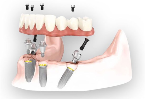 Dantų implantai: kaip tai veikia? Kokia technologija ir ateitis?