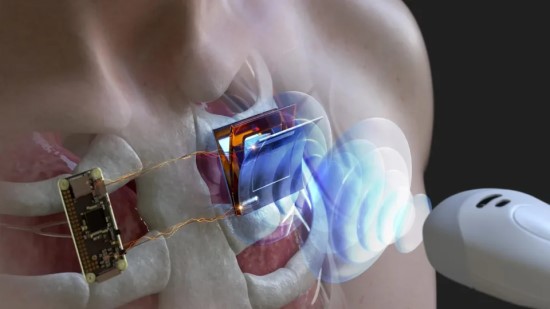 Pacientų laukia perversmas medicinoje: nauja technologija leis įkrauti širdies implantus be operacijos Pacientų laukia perversmas medicinoje: nauja technologija leis įkrauti širdies implantus be operacijos