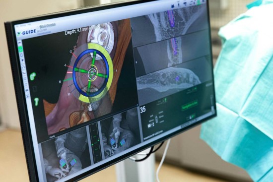 „X-Guide“ navigacinė implantacija